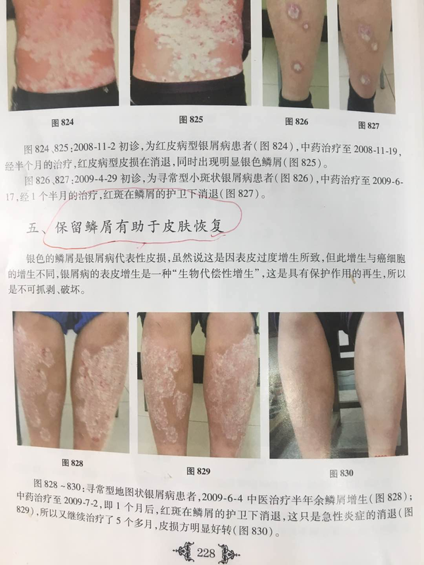 揭秘牛皮癣最新治疗进展，患者福音来临！